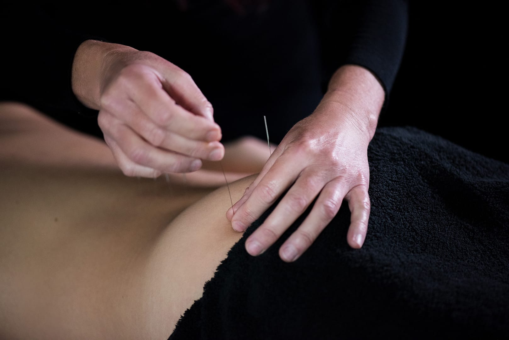 Dry Needling 180212-036
