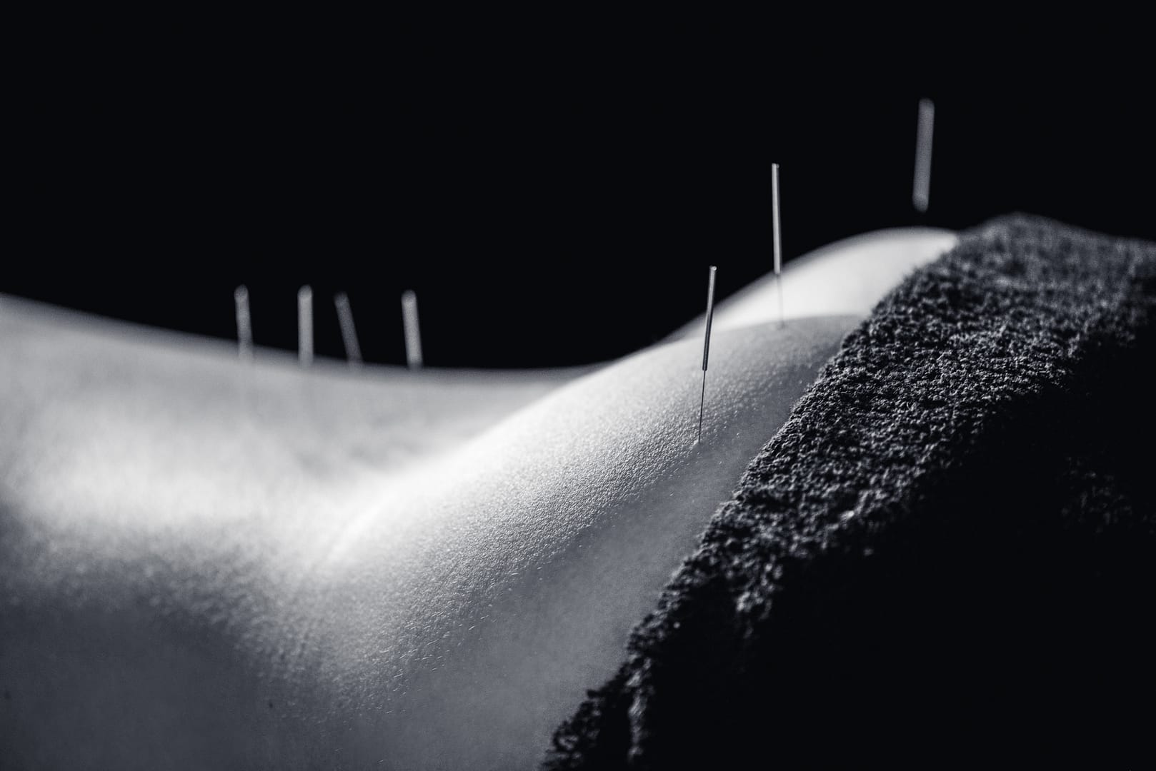 Dry Needling Dry Needling