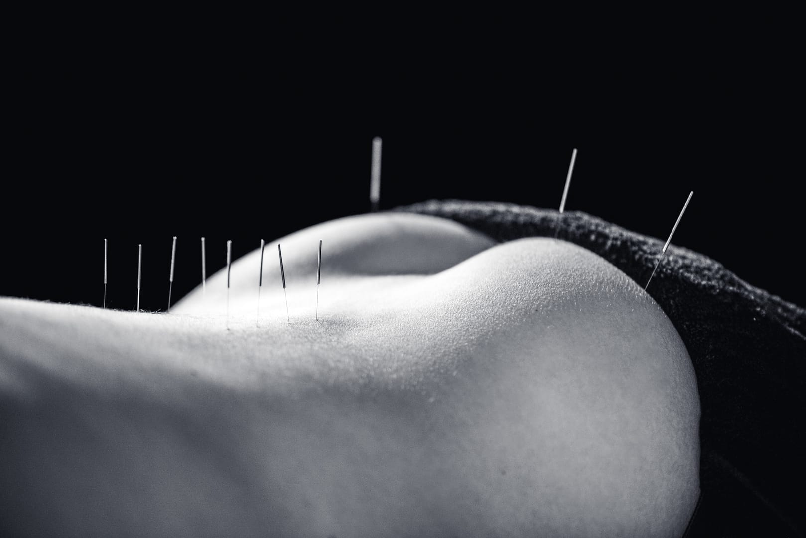 Acupuncture