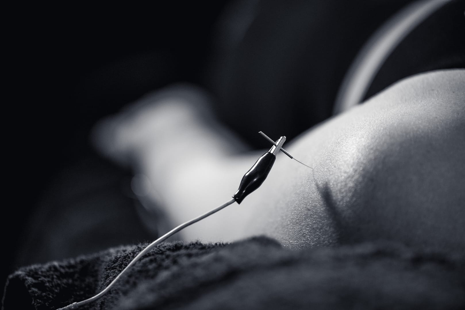 Electro Acupuncture