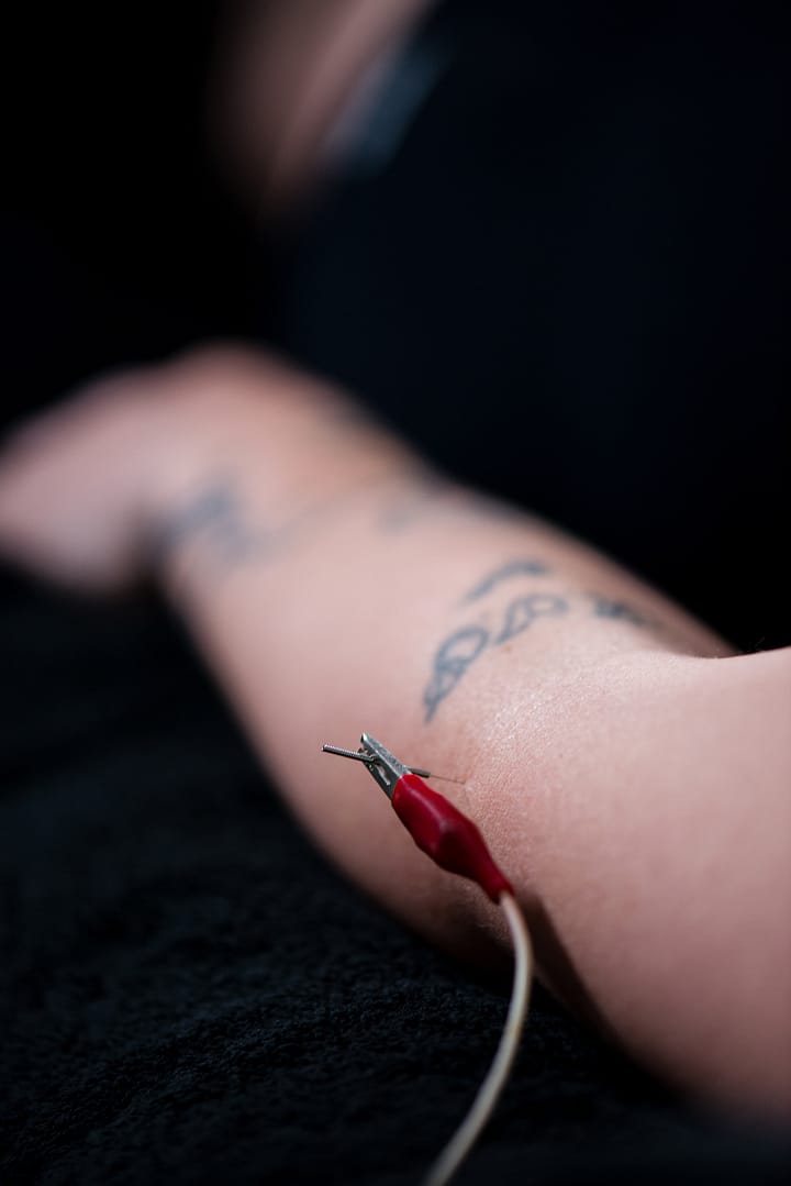 Electro Acupuncture